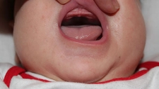Bebeklerde Damak Şişmesi Belirtileri ve Tedavisi