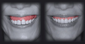 Damak Estetiği Nedir ve Nasıl Yapılır?