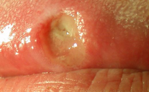 Ağız Damak Yarası Belirtileri ve Tedavisi