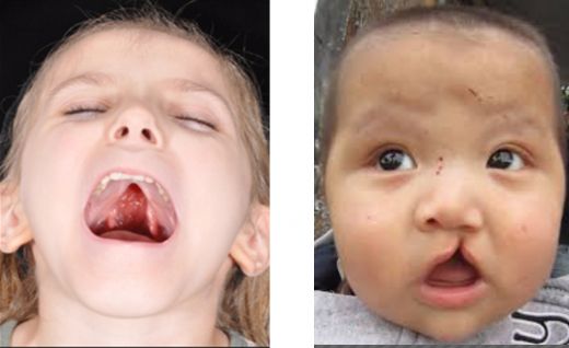 Bebeklerde Damak Yarığı Belirtileri ve Tedavisi