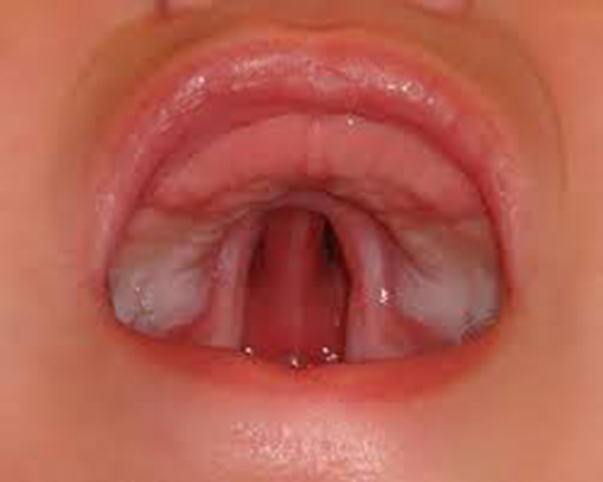 Bebeklerde Damak Düşmesi Belirtileri ve Tedavisi