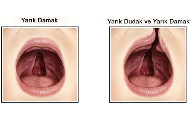 Damak Ameliyatı Riskleri ve Sonrası Damak Ameliyatı Riskleri ve Sonrası