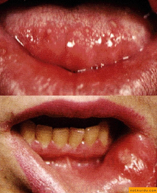 Damak Kabarması Belirtileri ve Tedavisi