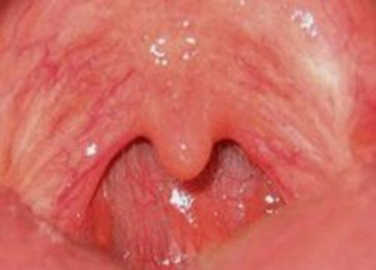 Damak Kanaması Belirtileri ve Tedavisi