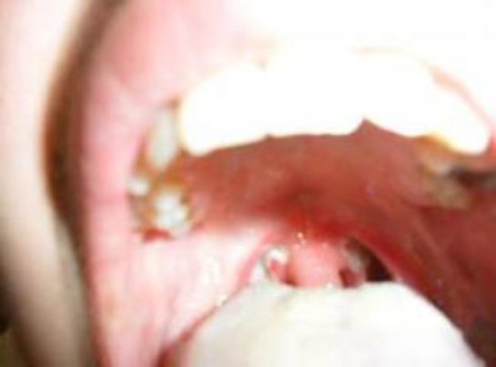 Damak Kanseri Belirtileri ve Tedavisi