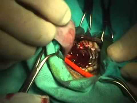 Damak Sarkması Belirtileri ve Tedavisi