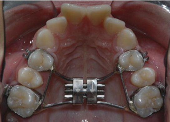 Damak Teli Kullanımı ve Faydaları Nelerdir?