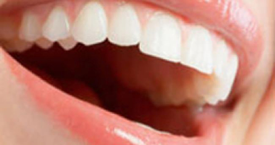 Damak Yarasına Ne İyi Gelir?