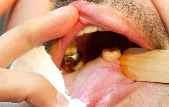 Damakta Diş Çıkması Belirtileri ve Tedavisi