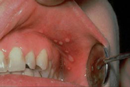 Sert Damak Kanseri Belirtileri ve Tedavisi