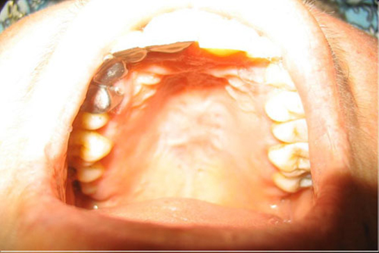 Üst Damak Ağrısı Belirtileri ve Tedavisi